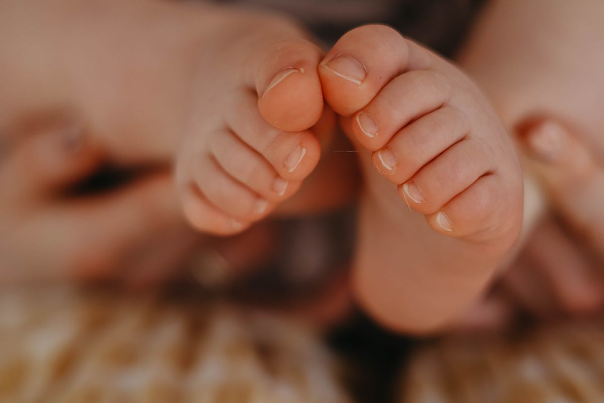 القدم الحنفاء (Talipes Equinovarus) - د. معتصم الدهون
