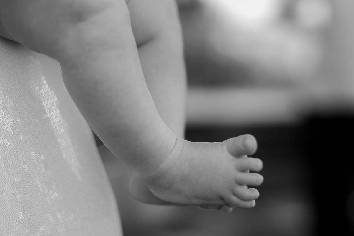 التشوهات الخلقية للأطراف عند الأطفال - علاج Congenital Limb Deformities - د. معتصم الدهون استشاري جراحة عظام الأطفال عمان الأردن