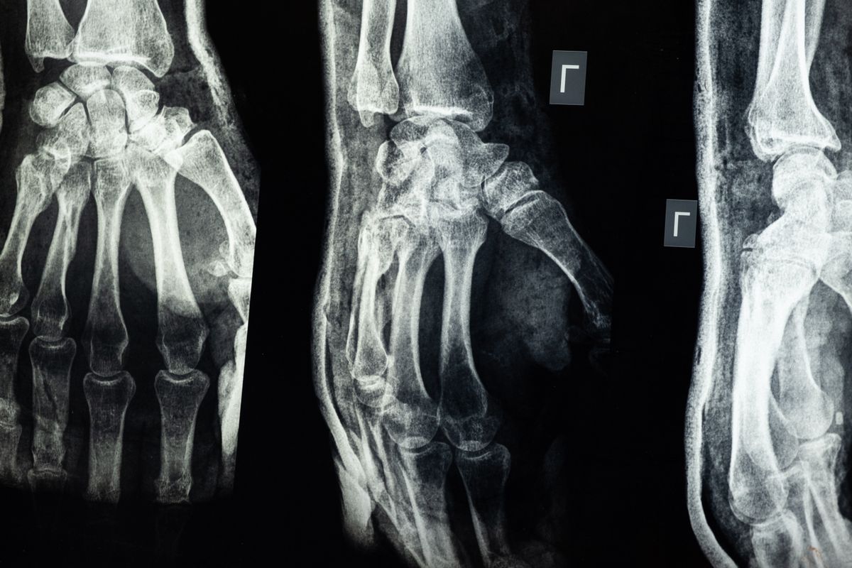 تشوّه بعد كسر قديم عند الأطفال: هل يمكن تصحيحه؟ - علاج Post-traumatic Malunion and Limb Length Discrepancy - د. معتصم الدهون استشاري جراحة عظام الأطفال عمان الأردن