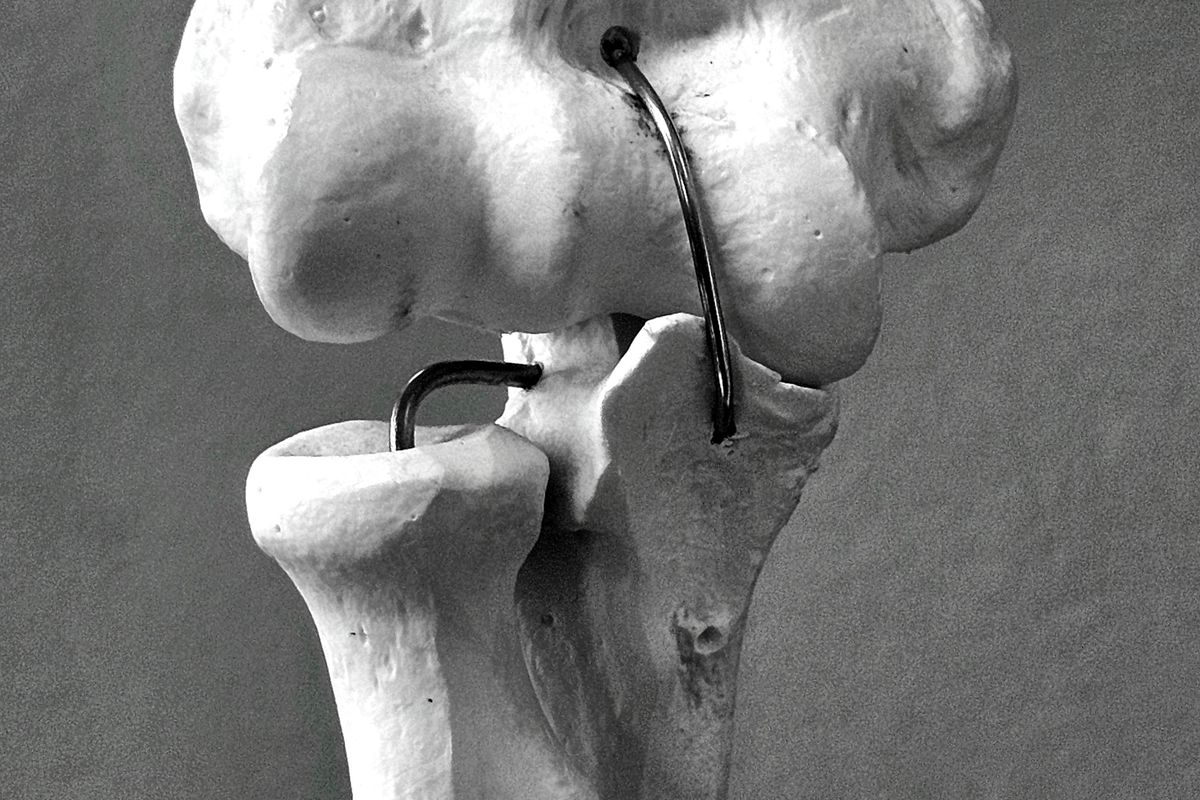 الورم العظمي الحميد (Osteochondroma) - علاج Osteochondroma - د. معتصم الدهون استشاري جراحة عظام الأطفال عمان الأردن