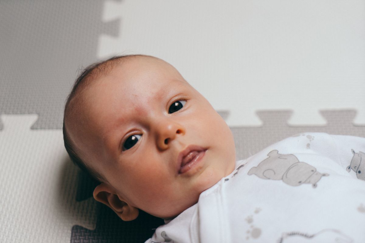 تسطح رأس الرضيع (Plagiocephaly)